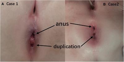 Case Report: Anal canal duplication associated with anorectal stenosis—A rare presentation